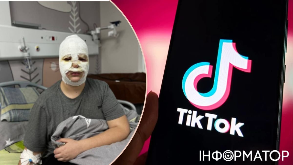 Небезпечний тренд у TikTok: троє дітей з опіками опинилися у львівській лікарні через саморобну петарду